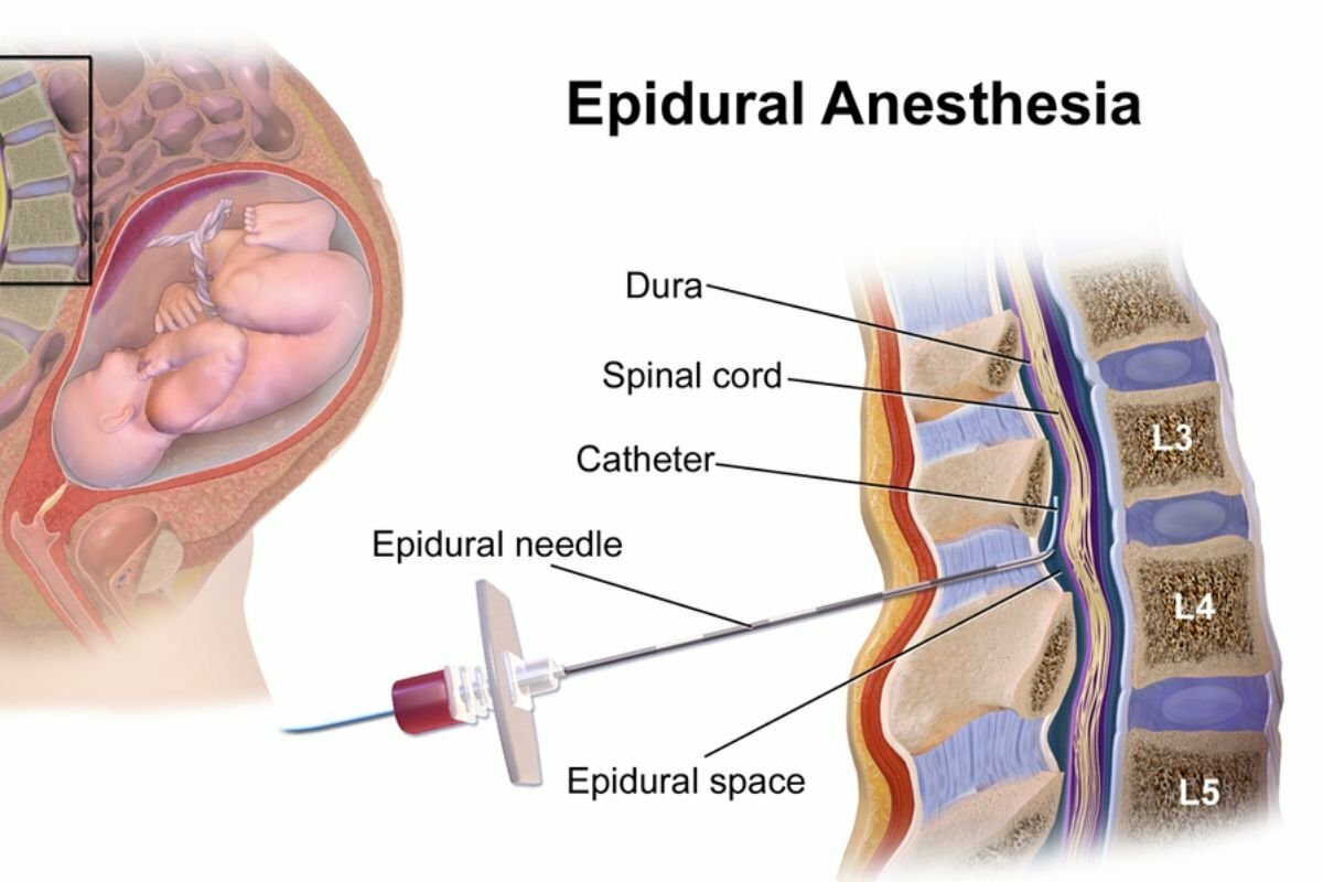 Epidural diagram